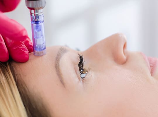 Aquagold Microneedling