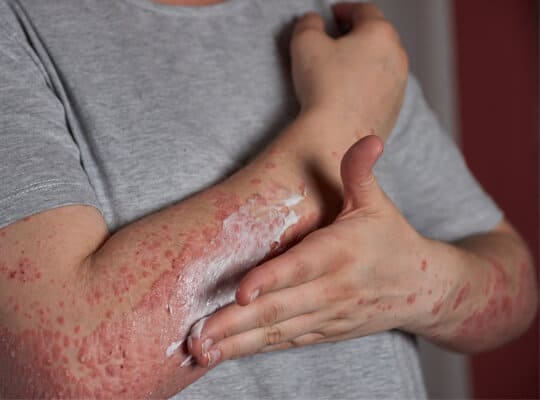 pro-magazine-living-with-psoriasis-2