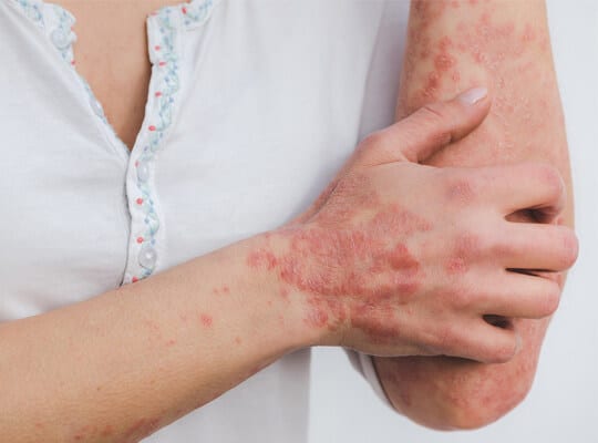 pro-magazine-living-with-psoriasis-3